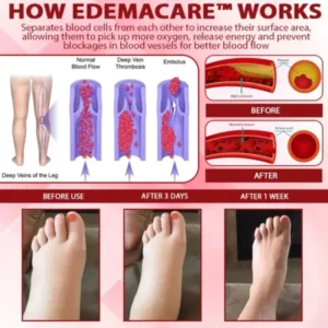 EdemaCare™ VenoLymph Massage Therapy Cream