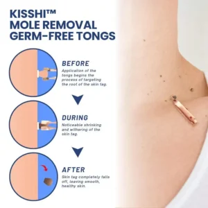 KISSHI™ Mole Removal Germ-Free Tongs