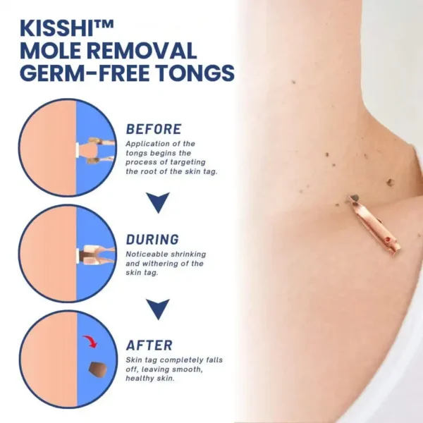 KISSHI™ Mole Removal Germ-Free Tongs